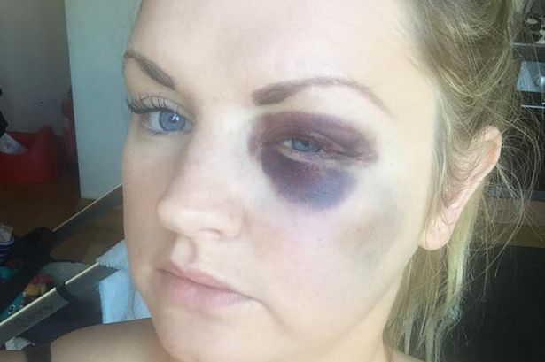 Bridesmaid Samantha Dewar was punched by her best friend's new husband at his wedding - and ended up with a black eye and broken cheekbone.