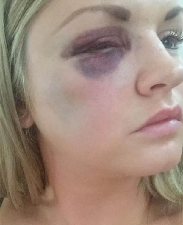 One of the pictures presented at court show a very bruised Samantha Dewar. Image: Manchester Evening News.